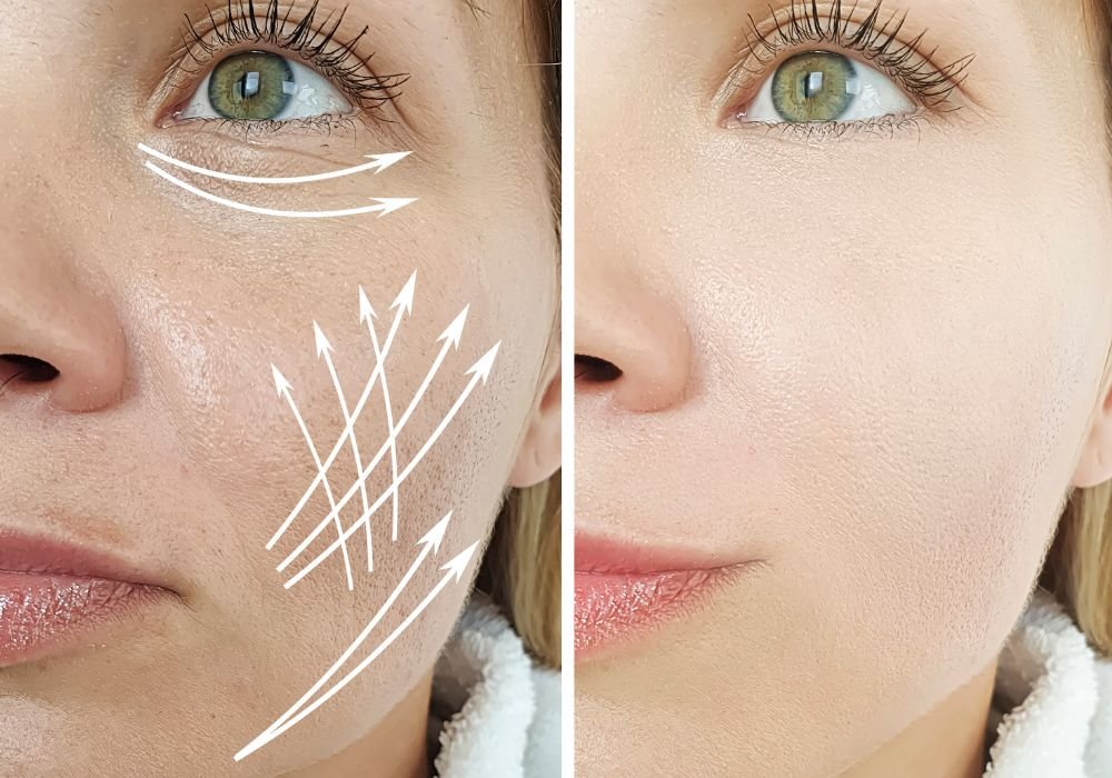 Résultat avant-après lifting facial - Dr Moreau Genève